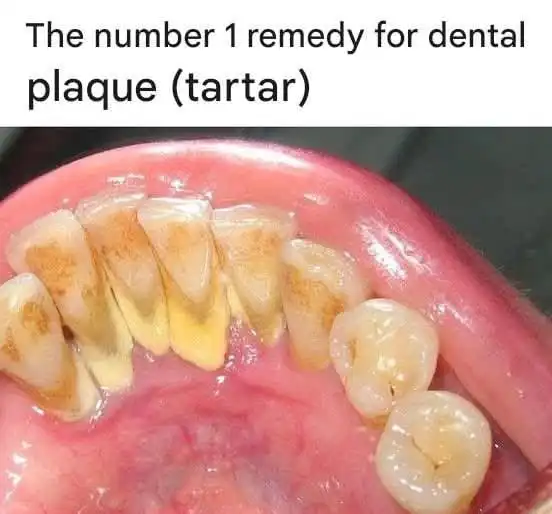 Le remède numéro 1 pour la plaque dentaire (tartre)