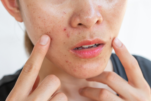 How to remove blackheads on the face?